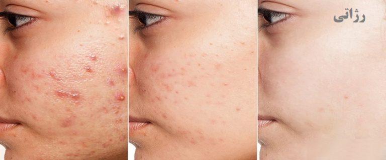 بهترین کرم ضد جوش قیمت مناسب رژاتی