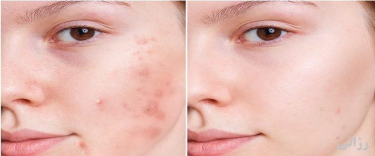 بهترین کرم ضد جوش و جای جوش صورت فروشگاه رژاتی